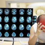 Primeros síntomas de un tumor cerebral